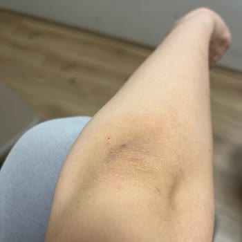 Glycolic Asit Kullanımı Sonrası Cilt Sorunları