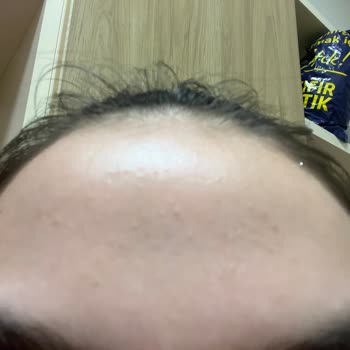 Glycolic Asit Kullanımı Sonrası Cilt Sorunları