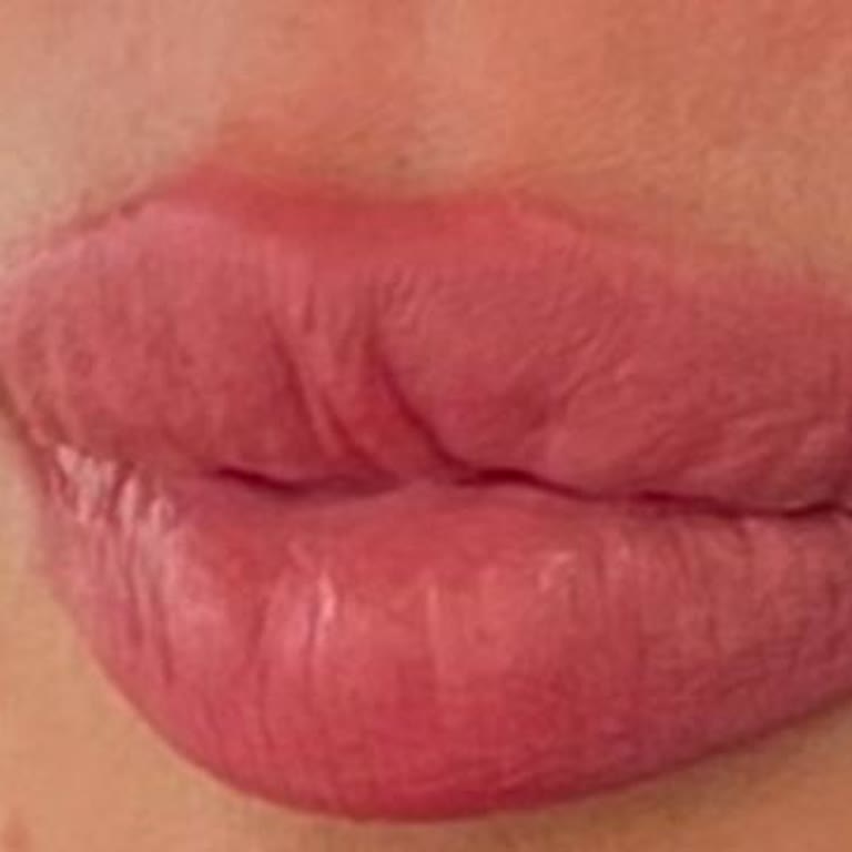 Bakırköy Este Clinic'te Dolgu Kabusu: Sürekli Değişen Doktorlar Ve Geçmeyen Sorunlar