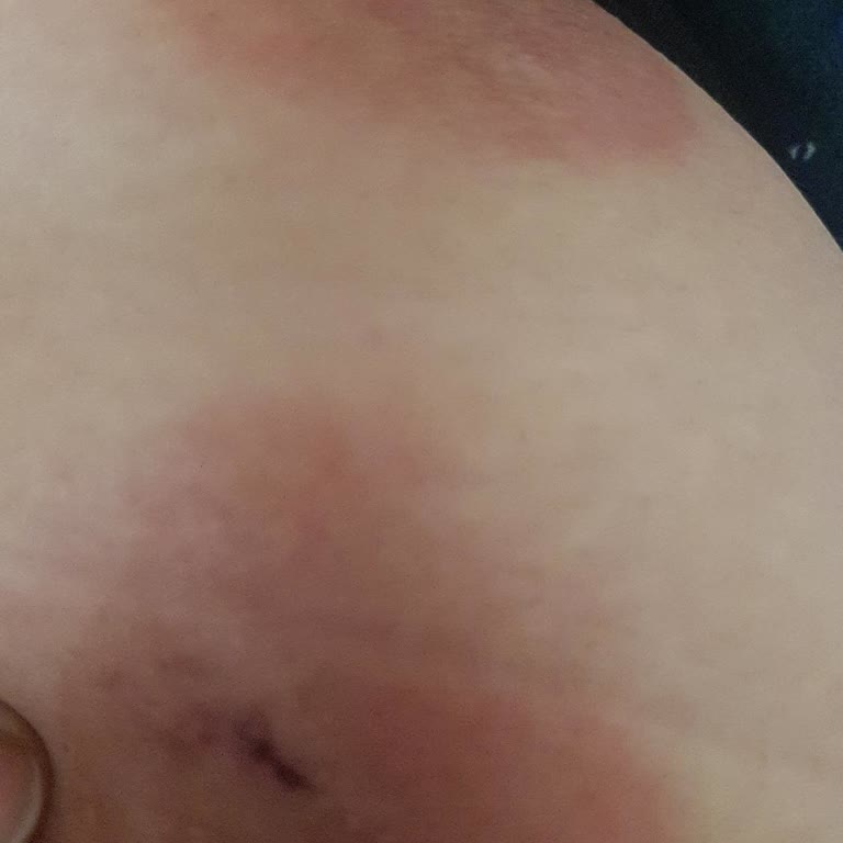 Ege Üniversitesi Hastanesi Dermatoloji Şikayetçiyim