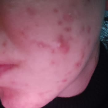 Flormar Fondöten Yüzümü Mahvetti!