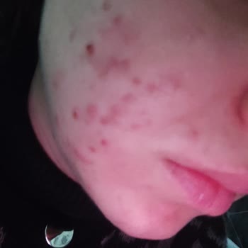 Flormar Fondöten Yüzümü Mahvetti!