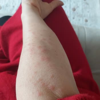 Neutrogena Ağır Alerji Oluşturuyor