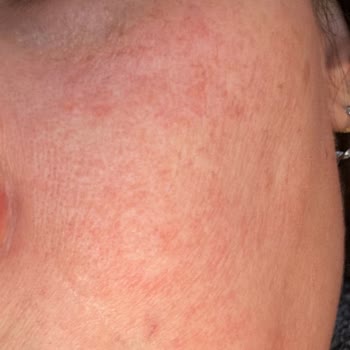 La Roche-Posay C12 Serum Caused Severe Redness and Irritation on Sensitive Skin