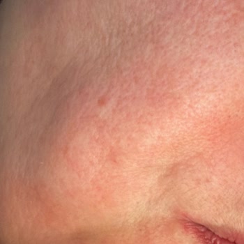 La Roche-Posay C12 Serum Caused Severe Redness and Irritation on Sensitive Skin