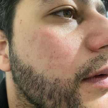 Trendyol'dan Aldığım Ürün Cildimi Mahvetti