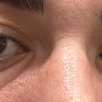 Skin Sensual C Vitamininden Kaynaklanan Cilt Reaksiyonu