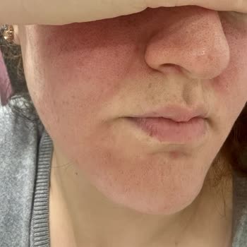 Skin Sensual C Vitamininden Kaynaklanan Cilt Reaksiyonu