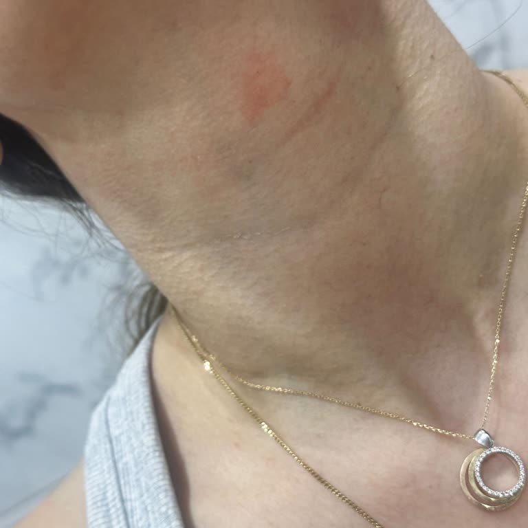 Cilt Ürününden Kaynaklanan Alerjik Reaksiyonlar