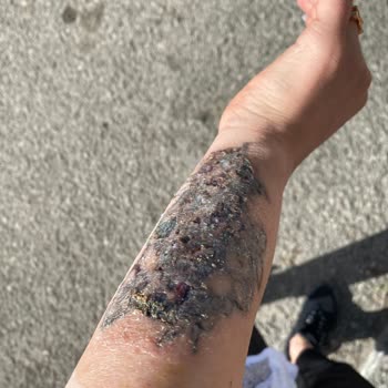 Dövme Sildirme Hizmetinde Yaşanan Ciddi Sorunlar