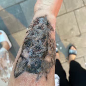 Dövme Sildirme Hizmetinde Yaşanan Ciddi Sorunlar