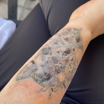 Dövme Sildirme Hizmetinde Yaşanan Ciddi Sorunlar