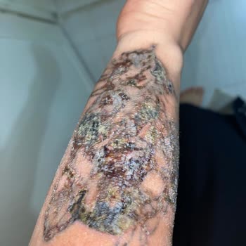 Dövme Sildirme Hizmetinde Yaşanan Ciddi Sorunlar