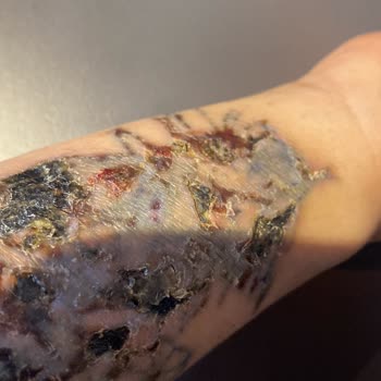 Dövme Sildirme Hizmetinde Yaşanan Ciddi Sorunlar