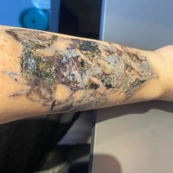 Dövme Sildirme Hizmetinde Yaşanan Ciddi Sorunlar