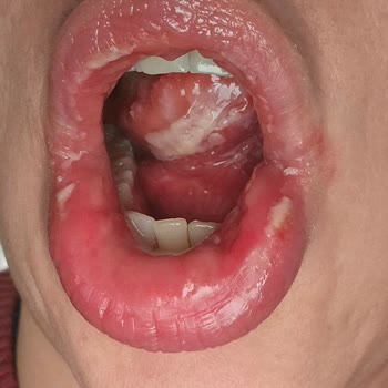 Diş Macunu Hassasiyeti: Şikayetler Ve Sağlık Sorunları