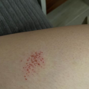 Cif Ultra Yağ Çözücü İle Yaşanan Kimyasal Yanık Sorunu