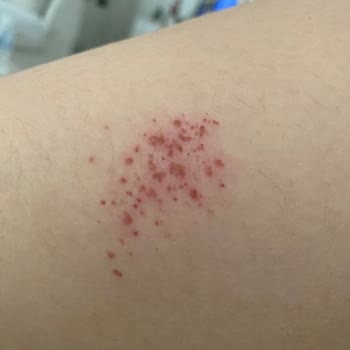 Cif Ultra Yağ Çözücü İle Yaşanan Kimyasal Yanık Sorunu