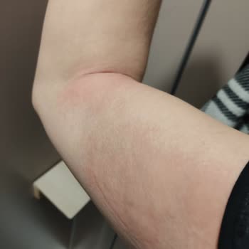 Yves Rocher Ürünleri Cilt Sorunlarına Yol Açtı, Acil Çözüm Bekliyorum