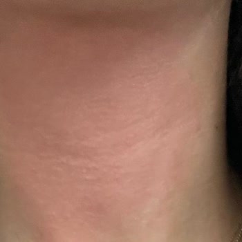 Alerjik Reaksiyon Ve Yetersiz Müşteri Hizmeti