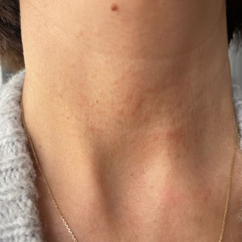 Alerjik Reaksiyon Ve Yetersiz Müşteri Hizmeti