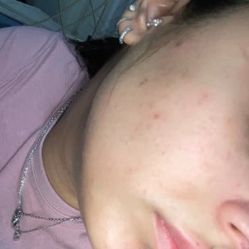 Derinlemesine Cilt Bakımı Sonrası Sorunlar