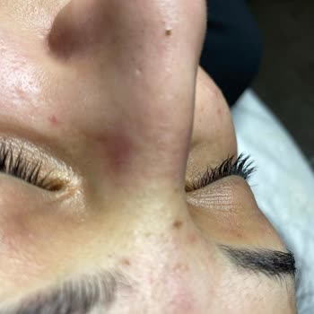 Derinlemesine Cilt Bakımı Sonrası Sorunlar