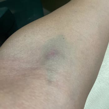 Hastanede Hijyen Sorunu Ve Personel Hatası