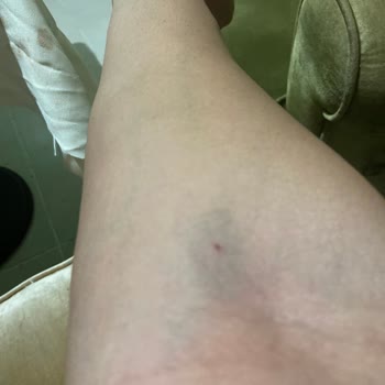 Hastanede Hijyen Sorunu Ve Personel Hatası