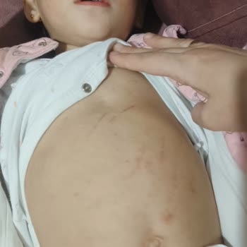 Goon Bebek Bezi Alerji Yaptı