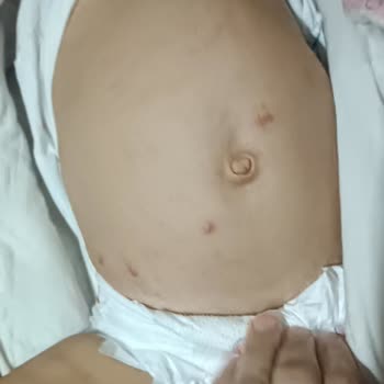Goon Bebek Bezi Alerji Yaptı