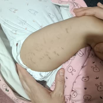 Goon Bebek Bezi Alerji Yaptı