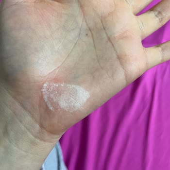 Vanish Kosla Kullanımı Sonrası Cilt Tahrişi