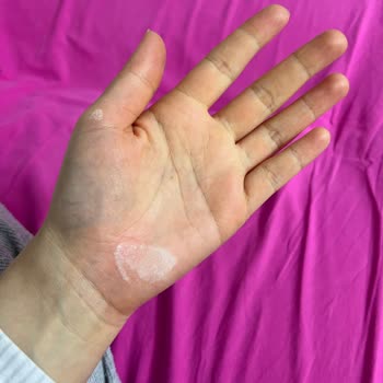 Vanish Kosla Kullanımı Sonrası Cilt Tahrişi