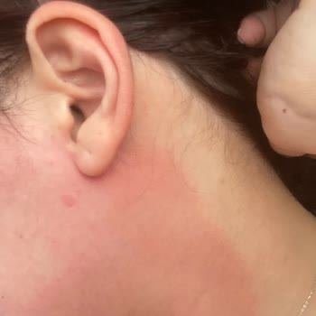 Loreal Paris Güneş Kremi Yüzümü Yaktı