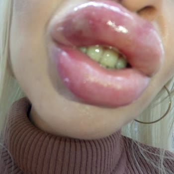 Dudak Dolgusu Kabusu: Sağlık Sorunları Ve Kötü Hizmet