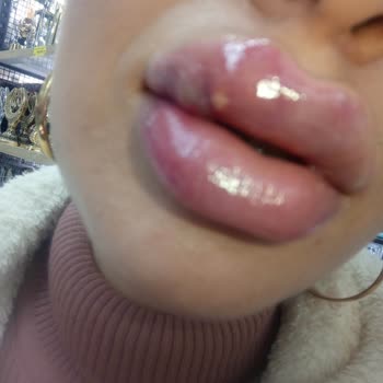 Dudak Dolgusu Kabusu: Sağlık Sorunları Ve Kötü Hizmet