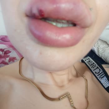 Dudak Dolgusu Kabusu: Sağlık Sorunları Ve Kötü Hizmet