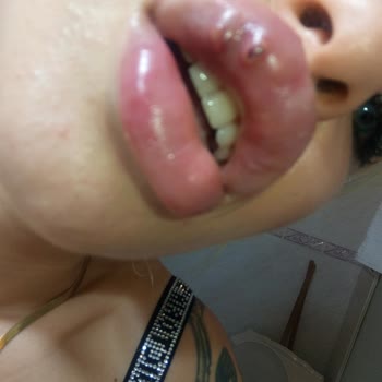 Dudak Dolgusu Kabusu: Sağlık Sorunları Ve Kötü Hizmet