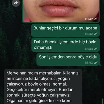 Yanlış Epilasyon Sonucu Kalıcı Yanık Ve İlgisizlik
