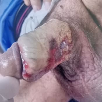 Tepecek Eğitim Hastanesi'nde Kötü Ameliyat Deneyimi