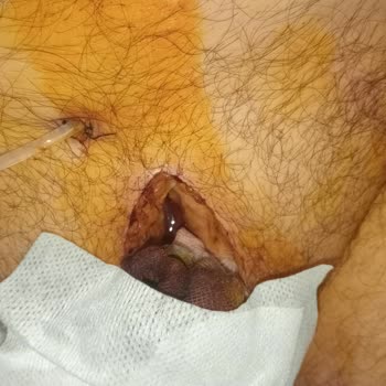 Tepecek Eğitim Hastanesi'nde Kötü Ameliyat Deneyimi