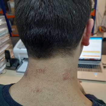 Yanlış Uygulama Ve Yetersiz Hizmet Nedeniyle Artan Tüylenme