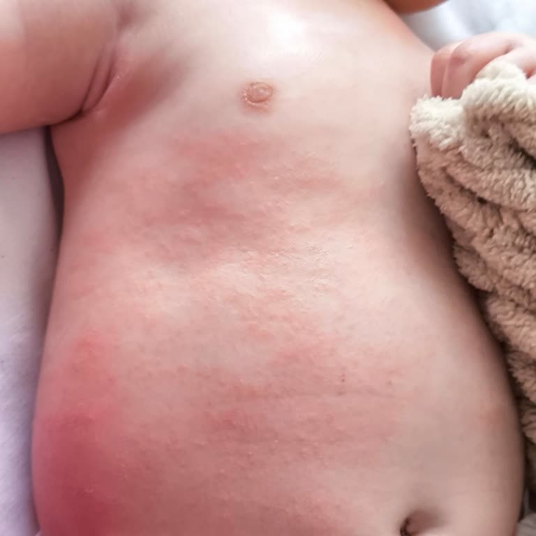 Mustela Ürünleri Çocuğumda Alerji Yaptı!