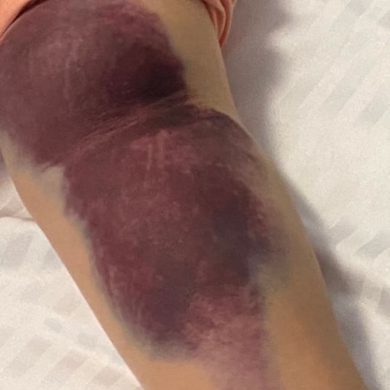 Yoğun Bakımda Yetersiz Hemşirelik Hizmeti