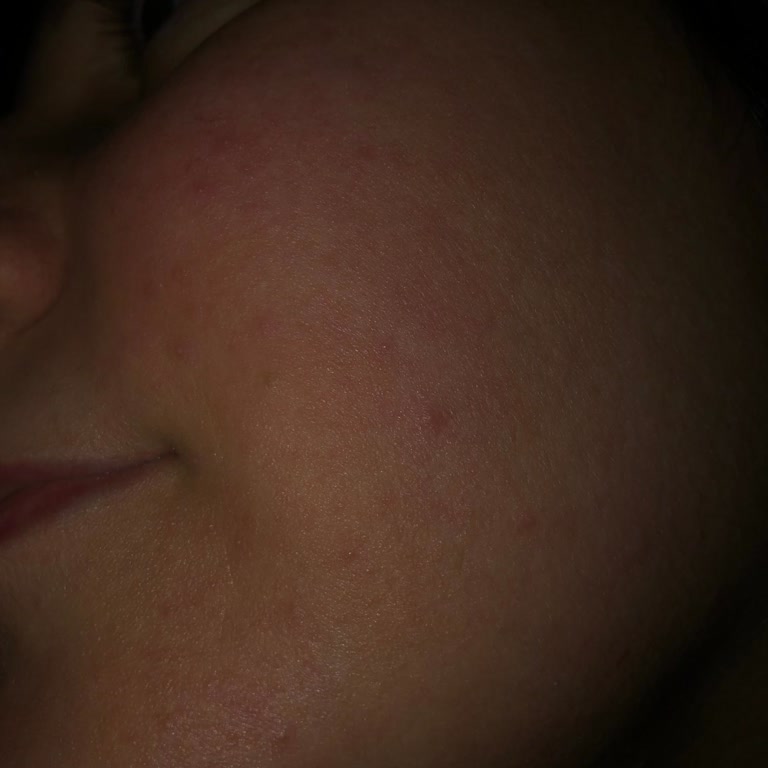 Sinoz Toniği Kullanımı Sonrası Cilt Sorunları