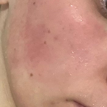 Yves Rocher Ürünleri Cildimde Yanma Ve Kızarıklık Yapıyor