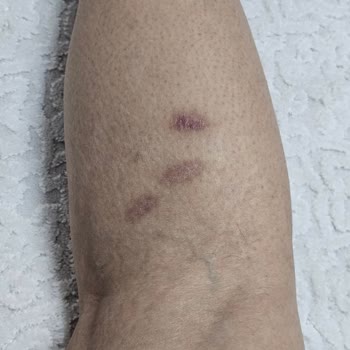 Lazer Seansında Yaşanan Ciddi Yanık Problemi Ve İlgisizlik