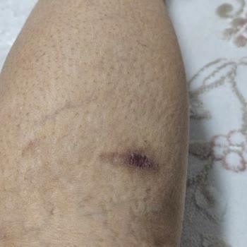 Lazer Seansında Yaşanan Ciddi Yanık Problemi Ve İlgisizlik