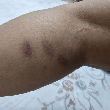 Lazer Seansında Yaşanan Ciddi Yanık Problemi Ve İlgisizlik